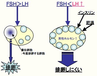 多嚢胞性卵巣症候