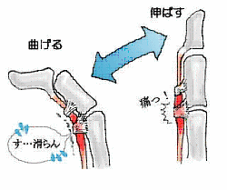 バネ指