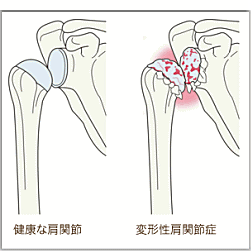 変形性肩関節症