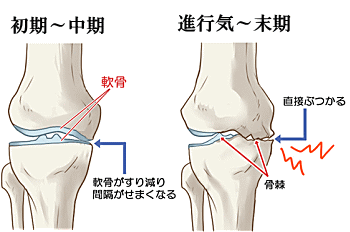 変形性膝関節症