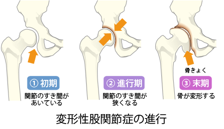 変形性股関節症