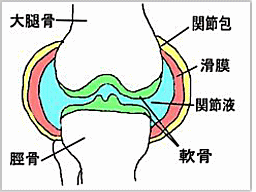 膝に水がたまる