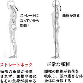 ストレートネック1