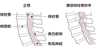 脊柱管狭窄症