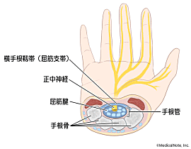 手根管症候群