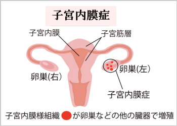 子宮内膜症