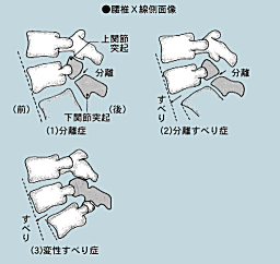 すべり症