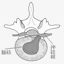 椎間板ヘルニア2