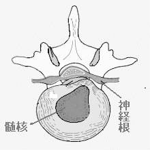 椎間板ヘルニア3