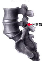 腰椎分離症