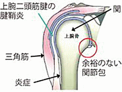 肩関節周囲炎（五十肩）